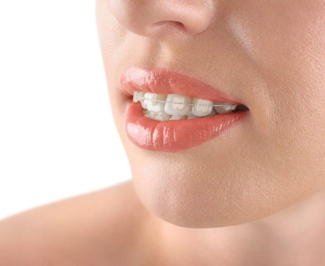 Teeth alignment. Braces. Beautiful woman smiling. Teeth alignment. Braces. Beautiful woman smiling. White background.