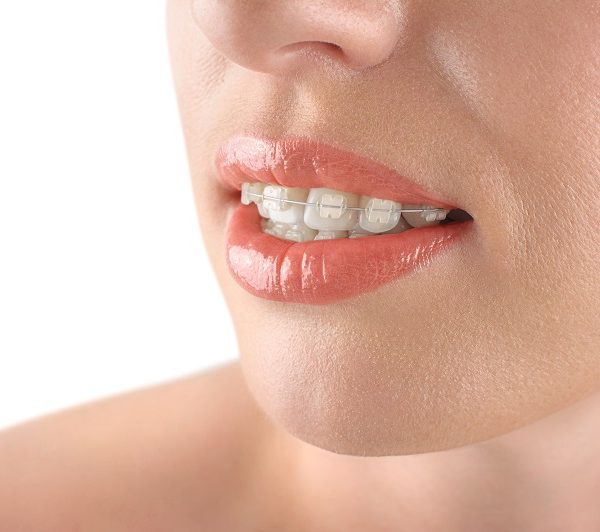 Teeth alignment. Braces. Beautiful woman smiling. Teeth alignment. Braces. Beautiful woman smiling. White background.