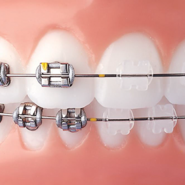 estetikortodonti6 estetikortodonti6