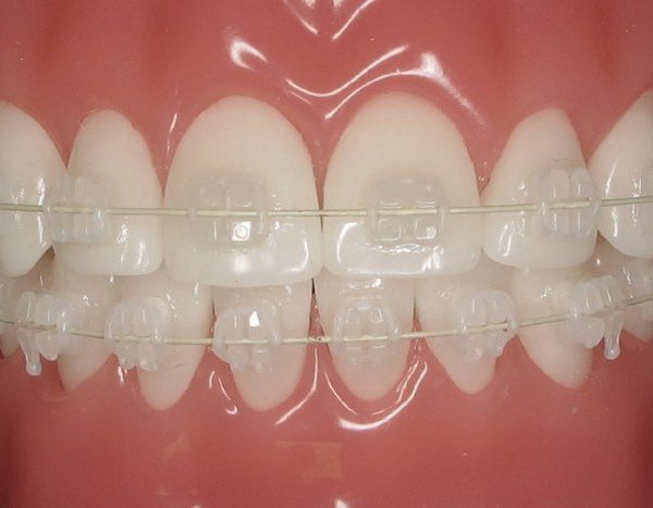 estetikortodonti7 estetikortodonti7