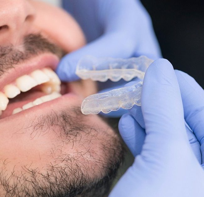 invisalign4 invisalign4